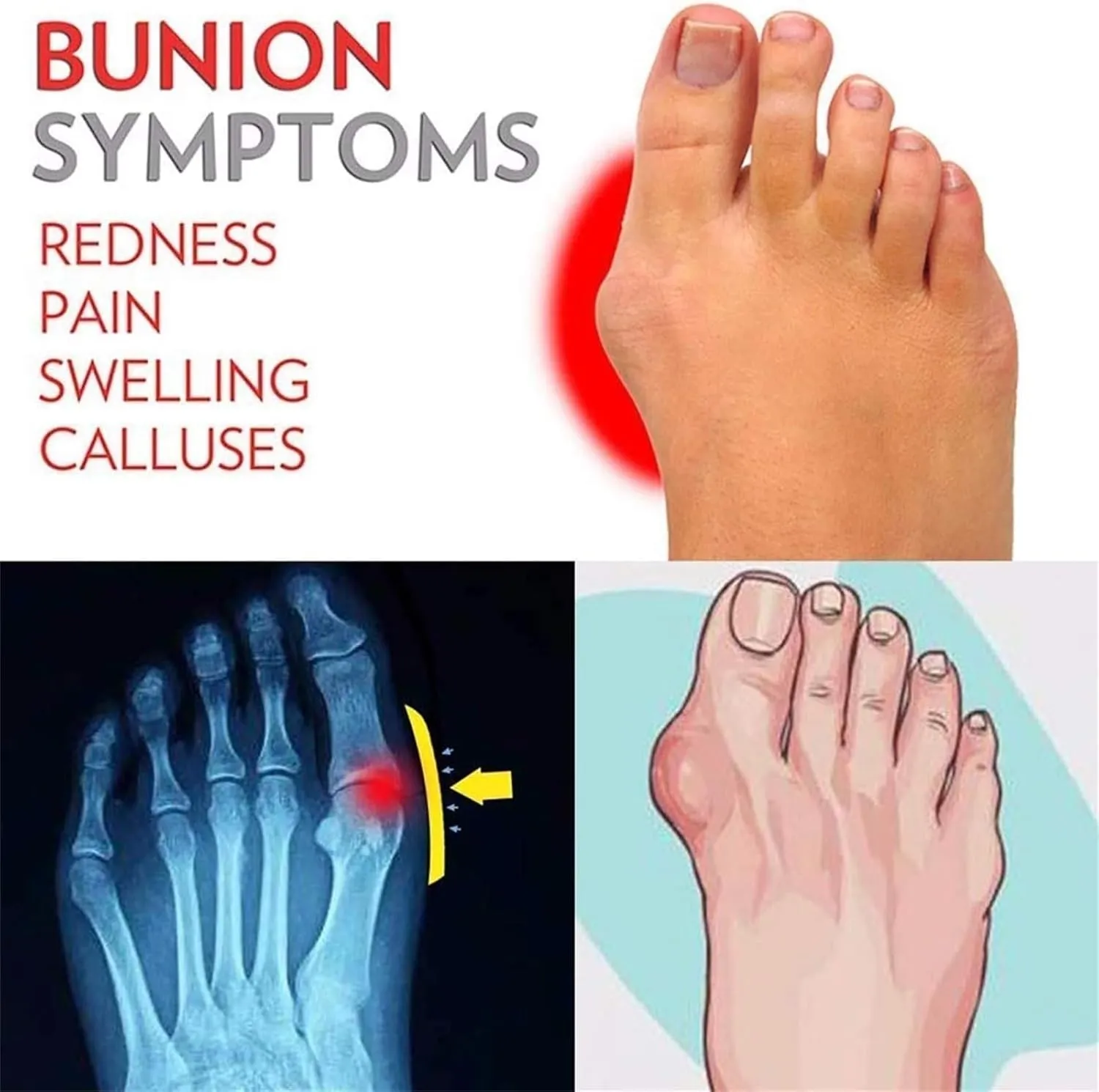 Mens Sandals Slippers, Men Summer Casual Slip-On Breathable Orthopedic Bunion Correction Sandals, Unique for Men, Beach Ring Toe Walking Orthopedic Flip Flops